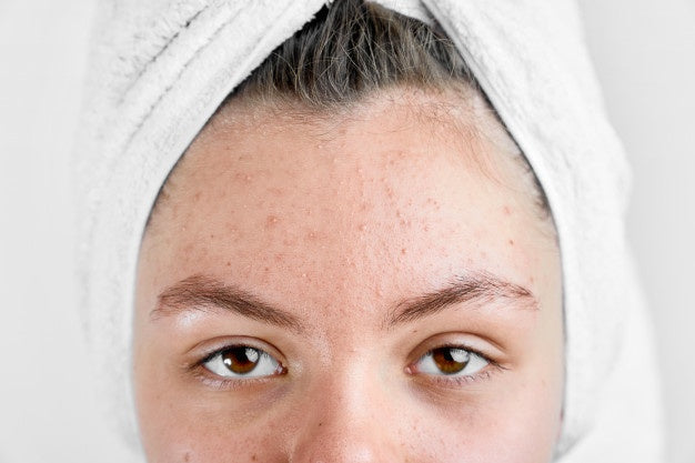 Face oil to treat Oily or Acne-prone skin