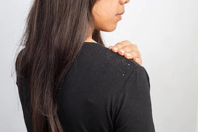 Winter Dandruff? Here's how to approach your battle against itchy, dry and dandruff prone scalp